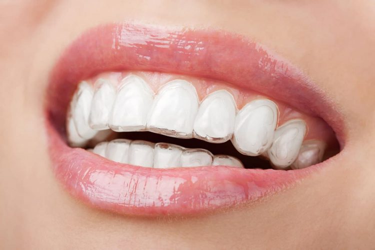 teeth whitening dentist sydney