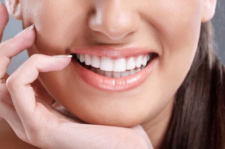 dental-veneers